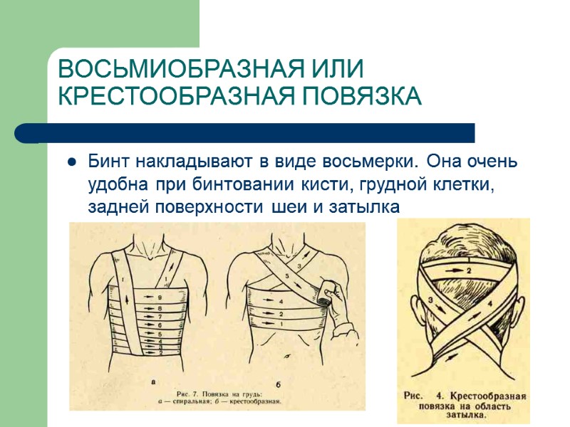 ВОСЬМИОБРАЗНАЯ ИЛИ КРЕСТООБРАЗНАЯ ПОВЯЗКА  Бинт накладывают в виде восьмерки. Она очень удобна при